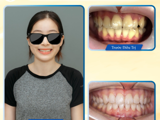 NIỀNG RĂNG NHA KHOA BMT