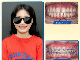 NIỀNG RĂNG TẠI BMT 