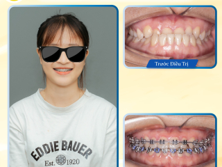 Niềng răng thẩm mỹ