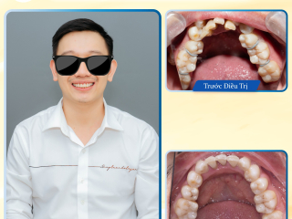 khách hàng trước và sau khi niềng răng tại Nha khoa BMT - Nha khoa Dr. Minh