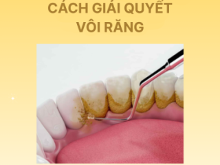 Cách Giải Quyết Vôi Răng Dưới Nướu
