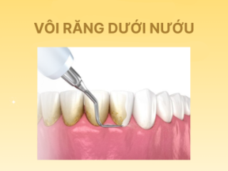 Vôi Răng Dưới Nướu – Lột Trần Sự Thật Về Nguy Cơ 