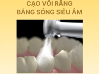 Cạo Vôi Răng Bằng Sóng Siêu Âm: Giải Pháp Tối Ưu Cho Nụ Cười Rạng Rỡ