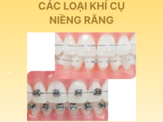 Các Loại Khí Cụ Niềng Răng Phổ Biến Hiện Nay