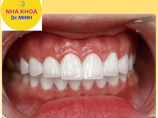 BỌC RĂNG SỨ THẨM MỸ