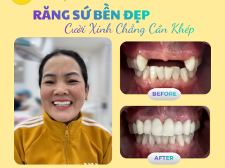 DỊCH VỤ RĂNG SỨ NHA KHOA BMT