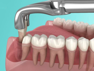 NHỔ RĂNG KHÔN KHÔNG ĐAU