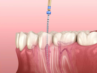 NỘI NHA CHỮA TỦY RĂNG 