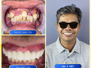 DỊCH VỤ RĂNG SỨ NHA KHOA BMT 