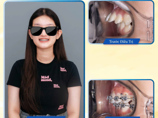 TRƯỚC SAU NIỀNG RĂNG TẠI NHA KHOA BMT 