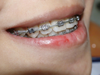 NIỀNG RĂNG MẮC CÀI 