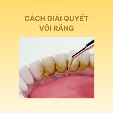 Cách Giải Quyết Vôi Răng Dưới Nướu