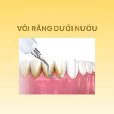 Vôi Răng Dưới Nướu – Lột Trần Sự Thật Về Nguy Cơ 