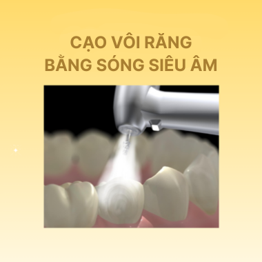 Cạo Vôi Răng Bằng Sóng Siêu Âm: Giải Pháp Tối Ưu Cho Nụ Cười Rạng Rỡ