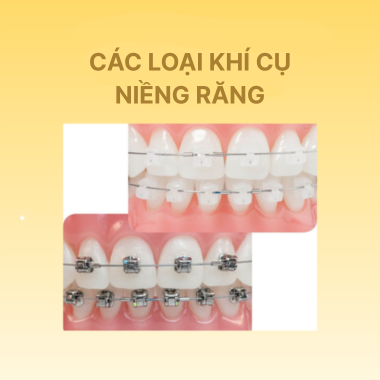 Các Loại Khí Cụ Niềng Răng Phổ Biến Hiện Nay