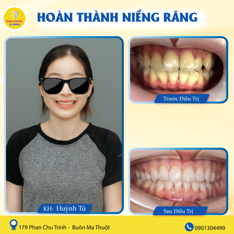 NIỀNG RĂNG NHA KHOA BMT