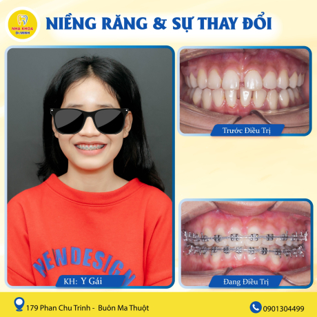 NIỀNG RĂNG TẠI BMT 