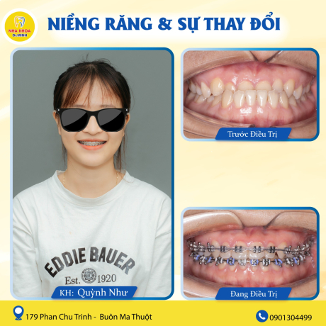 Niềng răng thẩm mỹ