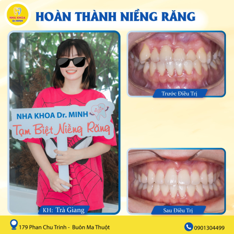 NIỀNG RĂNG DAK LAK