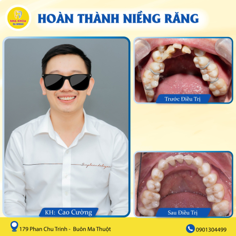 khách hàng trước và sau khi niềng răng tại Nha khoa BMT - Nha khoa Dr. Minh