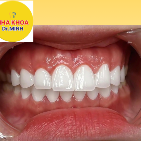 BỌC RĂNG SỨ THẨM MỸ