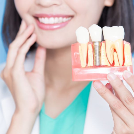 DỊCH VỤ IMPLANT CHẤT LƯỢNG CAO