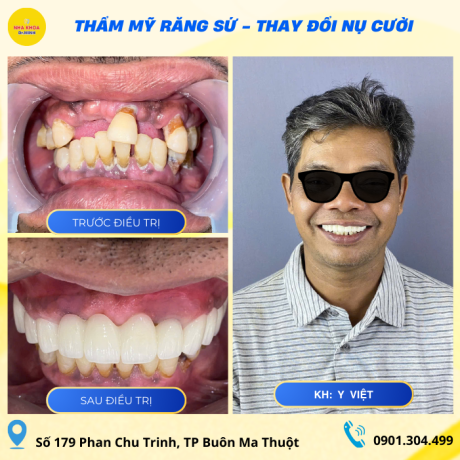 DỊCH VỤ RĂNG SỨ NHA KHOA BMT 