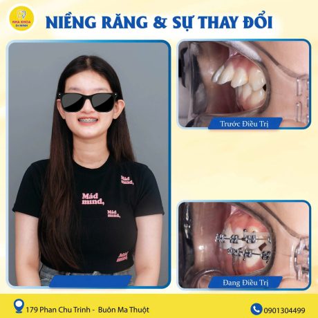 TRƯỚC SAU NIỀNG RĂNG TẠI NHA KHOA BMT 