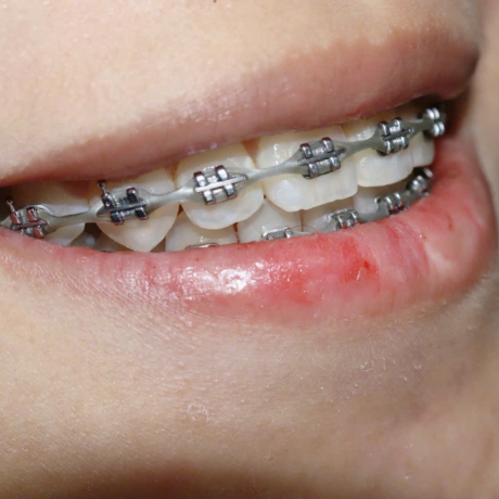 NIỀNG RĂNG MẮC CÀI 